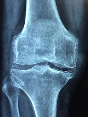 Determinate morfologie ossee del femore e della tibia incrementano il rischio di artrosi del ginocchio